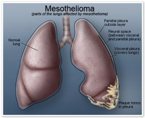 Mesothelioma Effects